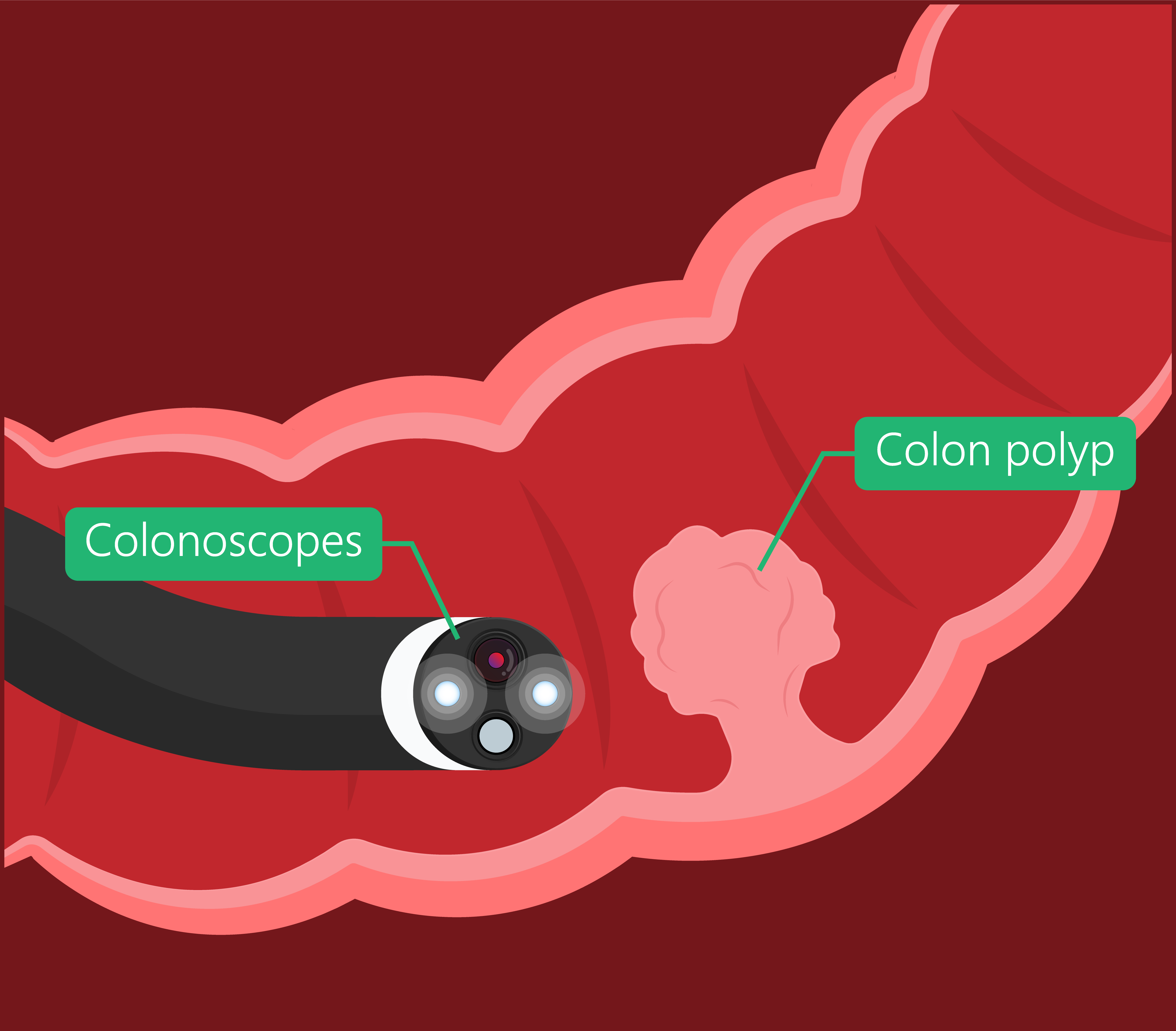 Advanced Endoscopic Resection